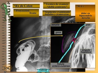 *Rx de Colon*Rx de Colon
**Proyección:Proyección:
frentefrente
**Técnica de examen:Técnica de examen:
““doble contraste”doble contraste”
**Segmento examinadoSegmento examinado
ángulos y transversoángulos y transverso
E ME M
UNTUNT
*M. C.:*M. C.:
dolor endolor en
hipocondriohipocondrio
derechoderecho
NMNM
N
detalledetalle
fístulafístula
entero-cutáneaentero-cutánea
pielpiel
gasagasa
ánguloángulo
hepáticohepático
volvervolver
 