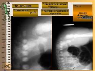 *Rx de Colon*Rx de Colon
**Proyección:Proyección:
**Técnica de examen:Técnica de examen:
**Segmento examinadoSegmento examinadoE ME M
UNTUNT
*M. C.:*M. C.:
neonatoneonato
distensióndistensión
abdominalabdominal
NMNM
N
detalledetalle
perfilperfil
““directa”directa”
sigmoidessigmoides
 
