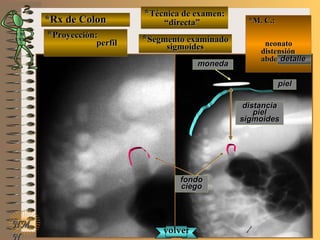 *Rx de Colon*Rx de Colon
**Proyección:Proyección:
perfilperfil
**Técnica de examen:Técnica de examen:
““directa”directa”
**Segmento examinadoSegmento examinado
sigmoidessigmoides
E ME M
UNTUNT
*M. C.:*M. C.:
neonatoneonato
distensióndistensión
abdominalabdominal
NMNM
N
detalledetalle
fondofondo
ciegociego
pielpiel
monedamoneda
distanciadistancia
pielpiel
sigmoidessigmoides
volvervolver
 