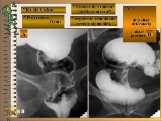 *Rx de Colon*Rx de Colon
**Proyección:Proyección:
**Técnica de examen:Técnica de examen:
**Segmento examinadoSegmento examinadoE ME M
UNTUNT
*M. C.:*M. C.:
dificultaddificultad
defecatoriadefecatoria
dolordolor
proctorragiaproctorragia
NMNM
N
AA BB
frentefrente
““doble contraste”doble contraste”
recto y sigmoidesrecto y sigmoides
 