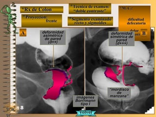 *Rx de Colon*Rx de Colon
**Proyección:Proyección:
frentefrente
**Técnica de examen:Técnica de examen:
““doble contraste”doble contraste”
**Segmento examinadoSegmento examinado
recto y sigmoidesrecto y sigmoides
E ME M
UNTUNT
*M. C.:*M. C.:
dificultaddificultad
defecatoriadefecatoria
dolordolor
proctorragiaproctorragia
NMNM
N
AA BB
imágenesimágenes
BorrrmannBorrrmann
tipo Itipo I
deformidaddeformidad
asimétricaasimétrica
de paredde pared
(d++)(d++)
deformidaddeformidad
simétrica desimétrica de
paredpared
(d+++)(d+++)
““mordiscomordisco
dede
manzana”manzana”
volvervolver
 