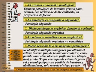 A-A-El examen es normal o patológico?El examen es normal o patológico?
Examen patológico de intestino grueso pano-Examen patológico de intestino grueso pano-
rámica, con técnica de doble contraste, enrámica, con técnica de doble contraste, en
proyección de frenteproyección de frente
B-B-La patología es congénita o adquirida?La patología es congénita o adquirida?
Patología adquiridaPatología adquirida
C-C- Dicha patología es orgánica, funcional o mixta?Dicha patología es orgánica, funcional o mixta?
**OpciónOpción
de volverde volver
a ver lasa ver las
imágenesimágenes
Patología adquirida orgánicaPatología adquirida orgánica
D-D-La misma es neoplásica o no neoplásica?La misma es neoplásica o no neoplásica?
Patología adquirida orgánica no neoplásicaPatología adquirida orgánica no neoplásica
E-E-Puede describir la o las imágenes patológicas?Puede describir la o las imágenes patológicas?
Se identifica múltiples imágenes que alteran elSe identifica múltiples imágenes que alteran el
relieve interno fino de la mucosa colónica, com-relieve interno fino de la mucosa colónica, com-
patible con colitis ulcerosa (inflamación idiopá-patible con colitis ulcerosa (inflamación idiopá-
tica) grado IV que corresponde estenosis gene-tica) grado IV que corresponde estenosis gene-
ral y pseudopólipos con pérdida de haustras yral y pseudopólipos con pérdida de haustras y
abollonaduras, solo respetó el ciego y rectoabollonaduras, solo respetó el ciego y recto
**Opción avanzada para volver a ver las imágenes con reparosOpción avanzada para volver a ver las imágenes con reparos
NMNM
D. F. M.D. F. M.
UNTUNT
E ME M
UNTUNT
 