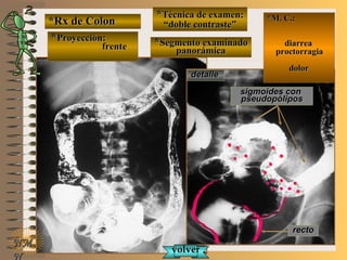 *Rx de Colon*Rx de Colon
**Proyección:Proyección:
frentefrente
**Técnica de examen:Técnica de examen:
““doble contraste”doble contraste”
**Segmento examinadoSegmento examinado
panorámicapanorámica
E ME M
UNTUNT
*M. C.:*M. C.:
diarreadiarrea
proctorragiaproctorragia
dolordolor
NMNM
N
detalledetalle
rectorecto
sigmoides consigmoides con
pseudopólipospseudopólipos
volvervolver
 