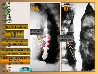 BBE ME M
UNTUNT
NMNM
*Rx de Esófago*Rx de Esófago
**Proyecciones:Proyecciones:
A- O.A.I.A- O.A.I.
B- O.A.D.B- O.A.D.
**Técnica de examen:Técnica de examen:
““relleno total”relleno total”
**Segmento examinado:Segmento examinado:
esófago toráxicoesófago toráxico
*M. C.:pacientes adultos*M. C.:pacientes adultos
con dolorcon dolor
retroesternalretroesternal
AA
O: ondasO: ondas
terciariasterciarias
volvervolver
O: ondasO: ondas
cuaternariascuaternarias
 