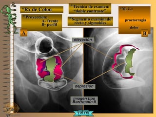 *Rx de Colon*Rx de Colon
**Proyección:Proyección:
A- frenteA- frente
B- perfilB- perfil
**Técnica de examen:Técnica de examen:
““doble contraste”doble contraste”
**Segmento examinadoSegmento examinado
recto y sigmoidesrecto y sigmoides
E ME M
UNTUNT
*M. C.:*M. C.:
proctorragiaproctorragia
dolordolor
NMNM
N
AA BB
imagen tipoimagen tipo
Borrrmann IIBorrrmann II
elevaciónelevación
depresióndepresión
volvervolver
 