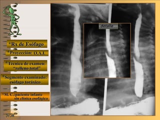E ME M
UNTUNT
NMNM
*Rx de Esófago*Rx de Esófago
**Proyección:Proyección:
**Técnica de examen:Técnica de examen:
**Segmento examinado:Segmento examinado:
*M. C.:paciente infante*M. C.:paciente infante
sin clínica esofágicasin clínica esofágica
detalledetalle
O.A.I.O.A.I.
““relleno total”relleno total”
esófago toráxicoesófago toráxico
 