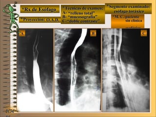 *Rx de Esófago*Rx de Esófago
**Proyección:Proyección:
**Técnicas de examen:Técnicas de examen:
A-A-
B-B-
C-C-
**Segmento examinado:Segmento examinado:
*M. C.:paciente*M. C.:paciente
sin clínicasin clínica
esofágicaesofágica
AA BB CC
NMNM
E ME M
UNTUNT
O.A.D.O.A.D.
““relleno total”relleno total”
““mucosografía”mucosografía”
““doble contraste”doble contraste”
esófago toráxicoesófago toráxico
 
