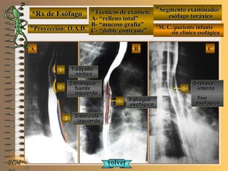 *Rx de Esófago*Rx de Esófago
**Proyección: O.A.D.Proyección: O.A.D.
**Técnicas de examen:Técnicas de examen:
A- “relleno total”A- “relleno total”
B- “mucoso grafía”B- “mucoso grafía”
C- “doble contraste”C- “doble contraste”
**Segmento examinado:Segmento examinado:
esófago toráxicoesófago toráxico
*M. C.:paciente infante*M. C.:paciente infante
sin clínica esofágicasin clínica esofágica
AA BB CC
NMNM
1-cayado1-cayado
aórticoaórtico
11
2-bronquio2-bronquio
fuentefuente
izquierdoizquierdo
22
3-aurícula3-aurícula
izquierdaizquierda33
44 4-pliegue4-pliegue
esofágicoesofágico
55
5-relieve5-relieve
internointerno
finofino
esofágicoesofágico
volvervolver
E ME M
UNTUNT
 