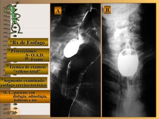 E ME M
UNTUNT
NMNM
*Rx de Esófago*Rx de Esófago
**Proyecciones:Proyecciones:
A-A-
B-B-
**Técnica de examen:Técnica de examen:
**Segmento examinado:Segmento examinado:
*M. C.:paciente con*M. C.:paciente con
disfagia, odinofágia,disfagia, odinofágia,
halitosis y toshalitosis y tos
BBAA
O.A.D.O.A.D.
FrenteFrente
““relleno total”relleno total”
esófago cervico-toráxicoesófago cervico-toráxico
 