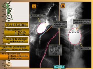 E ME M
UNTUNT
NMNM
*Rx de Esófago*Rx de Esófago
**Proyecciones:Proyecciones:
A- O.A.D.A- O.A.D.
B- FrenteB- Frente
**Técnica de examen:Técnica de examen:
““relleno total”relleno total”
**Segmento examinado:Segmento examinado:
esófago cervico-toráxicoesófago cervico-toráxico
*M. C.:paciente con*M. C.:paciente con
disfagia, odinofágia,disfagia, odinofágia,
halitosis y toshalitosis y tos
BBAA
divertículodivertículo
divertículodivertículo
volvervolver
paredpared
anterior deanterior de
la tráqueala tráquea
con bariocon bario
(tos)(tos)
nivel hidroaéreonivel hidroaéreo
(paciente de pie)(paciente de pie)compresióncompresión
divertículardivertícular
(disfagia)(disfagia)
 