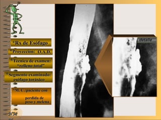 E ME M
UNTUNT
NMNM
*Rx de Esófago*Rx de Esófago
**Proyección:Proyección:
**Técnica de examen:Técnica de examen:
**Segmento examinado:Segmento examinado:
*M. C.:paciente con*M. C.:paciente con
perdida deperdida de
peso y melenapeso y melena
detalledetalle
O.A.D.O.A.D.
““relleno total”relleno total”
esófago toráxicoesófago toráxico
 