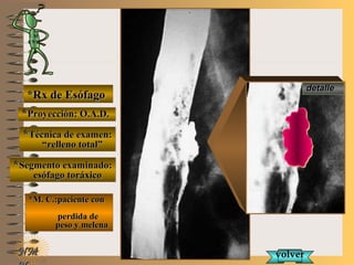 E ME M
UNTUNT
NMNM
*Rx de Esófago*Rx de Esófago
**Proyección: O.A.D.Proyección: O.A.D.
**Técnica de examen:Técnica de examen:
““relleno total”relleno total”
**Segmento examinado:Segmento examinado:
esófago toráxicoesófago toráxico
*M. C.:paciente con*M. C.:paciente con
perdida deperdida de
peso y melenapeso y melena
detalledetalle
volvervolver
 