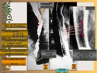 detalledetalle
E ME M
UNTUNT
NMNM
*Rx de Esófago*Rx de Esófago
**Proyecciones:Proyecciones:
A- O.A.I.A- O.A.I.
B- O.A.D.B- O.A.D.
**Técnica de examen:Técnica de examen:
A- “relleno total”A- “relleno total”
B- “doble contraste”B- “doble contraste”
**Segmento examinado:Segmento examinado:
esófago toráxicoesófago toráxico
*M. C.:paciente con*M. C.:paciente con
pirosispirosis
BBAA
herniahernia
hiatalhiatal
más reflujomás reflujo
imágenes elevadasimágenes elevadas
(focales)(focales)
que siguen elque siguen el
eje de uneje de un
plieguepliegue
volvervolver
ondasondas
terciariasterciarias
 