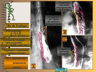 BB
AA
CC
E ME M
UNTUNT
NMNM
*Rx de Esófago*Rx de Esófago
**Proyecciones:Proyecciones:
A- O.A.D.A- O.A.D.
B y C- O.A.I.B y C- O.A.I.
**Técnica de examen:Técnica de examen:
A- “mucosografía”A- “mucosografía”
B y C- “doble contraste”B y C- “doble contraste”
**Segmento examinado:Segmento examinado:
esófago toráxicoesófago toráxico
*M. C.:paciente con*M. C.:paciente con
hematemesishematemesis
indoloraindolora
imágenesimágenes
en “faltaen “falta
de relleno”de relleno”
serpiginosasserpiginosas
imágenesimágenes
elevadaselevadas
serpiginosasserpiginosas
de frentede frente
imágenesimágenes
elevadaselevadas
de perfilde perfil
volvervolver
 