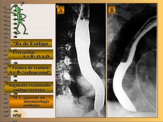 E ME M
UNTUNT
NMNM
*Rx de Esófago*Rx de Esófago
**Proyección:Proyección:
A y B-A y B-
**Técnica de examen:Técnica de examen:
A y B-A y B-
**Segmento examinado:Segmento examinado:
*M. C.:paciente sin*M. C.:paciente sin
sintomatologíasintomatología
esofágicaesofágica
BBAA
O.A.D.O.A.D.
““relleno total”relleno total”
esófago toráxicoesófago toráxico
 