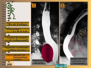 E ME M
UNTUNT
NMNM
*Rx de Esófago*Rx de Esófago
**Proyección:Proyección:
A y B- O.A.D.A y B- O.A.D.
**Técnica de examen:Técnica de examen:
A y B- “relleno total”A y B- “relleno total”
**Segmento examinado:Segmento examinado:
esófago toráxicoesófago toráxico
*M. C.:paciente sin*M. C.:paciente sin
sintomatologíasintomatología
esofágicaesofágica
BBAA
aneurismaaneurisma
de aortade aorta
mega aurículamega aurícula
izquierda conizquierda con
marcapasomarcapaso
volvervolver
 