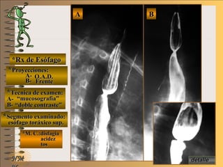 detalledetalle
E ME M
UNTUNT
*Rx de Esófago*Rx de Esófago
**Proyecciones:Proyecciones:
A-A-
B-B-
**Técnica de examen:Técnica de examen:
A-A-
B-B-
**Segmento examinado:Segmento examinado:
*M. C.:disfagia*M. C.:disfagia
acidezacidez
tostos
BBAA
NMNM
O.A.D.O.A.D.
FrenteFrente
““mucosografía”mucosografía”
““doble contraste”doble contraste”
esófago toráxico sup.esófago toráxico sup.
 
