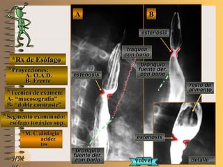 detalledetalle
E ME M
UNTUNT
*Rx de Esófago*Rx de Esófago
**Proyecciones:Proyecciones:
A- O.A.D.A- O.A.D.
B- FrenteB- Frente
**Técnica de examen:Técnica de examen:
A- “mucosografía”A- “mucosografía”
B- “doble contraste”B- “doble contraste”
**Segmento examinado:Segmento examinado:
esófago toráxico sup.esófago toráxico sup.
*M. C.:disfagia*M. C.:disfagia
acidezacidez
tostos
BBAA
NMNM
estenosisestenosis
estenosisestenosis
tráqueatráquea
con bariocon bario
bronquiobronquio
fuente der.fuente der.
con bariocon bario
resto deresto de
alimentoalimento
volvervolver
estenosisestenosis
bronquiobronquio
fuente der.fuente der.
con bariocon bario
 