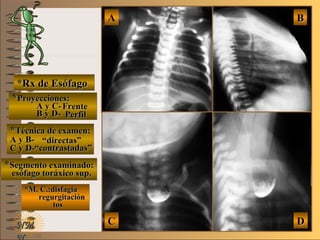 E ME M
UNTUNT
*Rx de Esófago*Rx de Esófago
**Proyecciones:Proyecciones:
A y C-A y C-
B y D-B y D-
**Técnica de examen:Técnica de examen:
A y B-A y B-
C y D-C y D-
**Segmento examinado:Segmento examinado:
*M. C.:disfagia*M. C.:disfagia
regurgitaciónregurgitación
tostos
NMNM
BBAA
DDCC
FrenteFrente
PerfilPerfil
““directas”directas”
““contrastadas”contrastadas”
esófago toráxico sup.esófago toráxico sup.
 