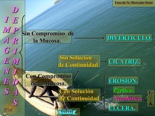 Foto de N. Mercado NietoFoto de N. Mercado Nieto
II
MM
AA
GG
EE
NN
EE
SS
DD
EE
PP
RR
II
MM
II
DD
AA
SS
Sin Compromiso deSin Compromiso de
la Mucosa.la Mucosa.
Con CompromisoCon Compromiso
de la Mucosa.de la Mucosa.
DIVERTICULO.DIVERTICULO.
Sin SoluciónSin Solución
de Continuidadde Continuidad
Con SoluciónCon Solución
de Continuidadde Continuidad
CICATRIZ.CICATRIZ.
EROSION.EROSION.
ULCERA.ULCERA.
Péptica.Péptica.
NeoplásicaNeoplásica..
T.T.
A.A.
NMNM volvervolver
 