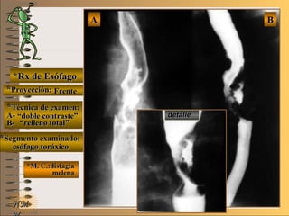 E ME M
UNTUNT
*Rx de Esófago*Rx de Esófago
**Proyección:Proyección:
**Técnica de examen:Técnica de examen:
A-A-
B-B-
**Segmento examinado:Segmento examinado:
*M. C.:disfagia*M. C.:disfagia
melenamelena
NMNM
BBAA
detalledetalle
FrenteFrente
““doble contraste”doble contraste”
““relleno total”relleno total”
esófago toráxicoesófago toráxico
 