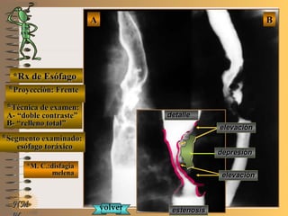 E ME M
UNTUNT
*Rx de Esófago*Rx de Esófago
**Proyección: FrenteProyección: Frente
**Técnica de examen:Técnica de examen:
A- “doble contraste”A- “doble contraste”
B- “relleno total”B- “relleno total”
**Segmento examinado:Segmento examinado:
esófago toráxicoesófago toráxico
*M. C.:disfagia*M. C.:disfagia
melenamelena
NMNM
BBAA
detalledetalle
depresióndepresión
volvervolver
elevaciónelevación
elevaciónelevación
estenosisestenosis
 