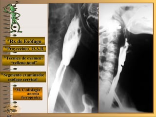 E ME M
UNTUNT
*Rx de Esófago*Rx de Esófago
**Proyección:Proyección:
**Técnica de examen:Técnica de examen:
**Segmento examinado:Segmento examinado:
*M. C.:disfagia*M. C.:disfagia
anemiaanemia
ferropénicaferropénica
NMNM
O.A.D.O.A.D.
““relleno total”relleno total”
esófago cervicalesófago cervical
 