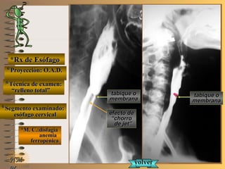 E ME M
UNTUNT
*Rx de Esófago*Rx de Esófago
**Proyección: O.A.D.Proyección: O.A.D.
**Técnica de examen:Técnica de examen:
““relleno total”relleno total”
**Segmento examinado:Segmento examinado:
esófago cervicalesófago cervical
*M. C.:disfagia*M. C.:disfagia
anemiaanemia
ferropénicaferropénica
NMNM
tabique otabique o
membranamembrana
tabique otabique o
membranamembrana
efecto deefecto de
““chorrochorro
de jet”de jet”
volvervolver
 