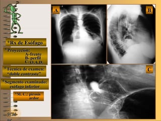 E ME M
UNTUNT
*Rx de Esófago*Rx de Esófago
**Proyección:Proyección:
A-A-
B-B-
C-C-
**Técnica de examen:Técnica de examen:
**Segmento examinado:Segmento examinado:
*M. C.: pirosis*M. C.: pirosis
ardorardor
NMNM
BBAA
CC
frentefrente
perfilperfil
O.A.D.O.A.D.
““doble contraste”doble contraste”
esófago inferioresófago inferior
 