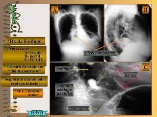 E ME M
UNTUNT
*Rx de Esófago*Rx de Esófago
**Proyección:Proyección:
A- frenteA- frente
B- perfilB- perfil
C- O.A.D.C- O.A.D.
**Técnica de examen:Técnica de examen:
““doble contraste”doble contraste”
**Segmento examinado:Segmento examinado:
esófago inferioresófago inferior
*M. C.: pirosis*M. C.: pirosis
ardorardor
NMNM
BBAA
CC
nivel hidroaereonivel hidroaereo
esófagoesófago
uniónunión
esófagoesófago
gástricagástrica
diafragmadiafragma
herniahernia
volvervolver
 