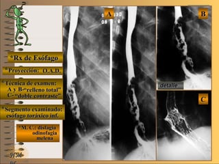 detalledetalle
stent post-stent post-
quirurgicoquirurgico
E ME M
UNTUNT
*Rx de Esófago*Rx de Esófago
**Proyección:Proyección:
**Técnica de examen:Técnica de examen:
A y B-A y B-
C-C-
**Segmento examinado:Segmento examinado:
*M. C.: disfagia*M. C.: disfagia
odinofagiaodinofagia
melenamelena
NMNM
BBAA
CC
detalledetalle
O.A.D.O.A.D.
““relleno total”relleno total”
““doble contraste”doble contraste”
esófago toráxico inf.esófago toráxico inf.
 