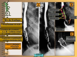 detalledetalle
stent post-stent post-
quirurgicoquirurgico
E ME M
UNTUNT
*Rx de Esófago*Rx de Esófago
**Proyección: O.A.D.Proyección: O.A.D.
**Técnica de examen:Técnica de examen:
A y B- “relleno total”A y B- “relleno total”
C- “doble contraste”C- “doble contraste”
**Segmento examinado:Segmento examinado:
esófago toráxico inf.esófago toráxico inf.
*M. C.: disfagia*M. C.: disfagia
odinofagiaodinofagia
melenamelena
NMNM
BBAA
CC
detalledetalle
depresióndepresión
elevaciónelevación
elevaciónelevación
herniahernia
stentstent
metálicometálico
volvervolver
CC
 