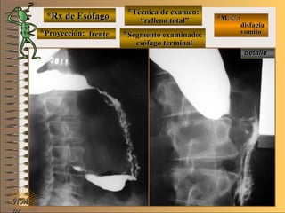 E ME M
UNTUNT
*Rx de Esófago*Rx de Esófago
**Proyección:Proyección:
**Técnica de examen:Técnica de examen:
**Segmento examinado:Segmento examinado:
*M. C.:*M. C.:
disfagiadisfagia
vomitovomito
NMNM
detalledetalle
frentefrente
““relleno total”relleno total”
esófago terminalesófago terminal
 