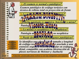 A-A-El examen es normal o patológico?El examen es normal o patológico?
Examen patológico de esófago toráxico conExamen patológico de esófago toráxico con
técnica de relleno total en proyección de frentetécnica de relleno total en proyección de frente
B-B-La patología es congénita o adquirida?La patología es congénita o adquirida?
Patología adquiridaPatología adquirida
C-C- Dicha patología es orgánica, funcional o mixta?Dicha patología es orgánica, funcional o mixta?
**OpciónOpción
de volverde volver
a ver lasa ver las
imágenesimágenes
Patología adquirida orgánicaPatología adquirida orgánica
D-D-La misma es neoplásica o no neoplásica?La misma es neoplásica o no neoplásica?
Patología adquirida orgánica no neoplásicaPatología adquirida orgánica no neoplásica
E-E-Puede describir la o las imágenes patológicas?Puede describir la o las imágenes patológicas?
Se identifica una alteración de tamaño y longitudSe identifica una alteración de tamaño y longitud
de esófago toráxico (dolico-mega) asociado a unade esófago toráxico (dolico-mega) asociado a una
estenosis orgánica céntrica y regular en esófagoestenosis orgánica céntrica y regular en esófago
distal, compatible con acalasia (destrucción dedistal, compatible con acalasia (destrucción de
plexos nerviosos de Meisner y Auebach)plexos nerviosos de Meisner y Auebach)
**Opción avanzada para volver a ver las imágenes con reparosOpción avanzada para volver a ver las imágenes con reparosNMNM
D. F. M.D. F. M.
UNTUNT
E ME M
UNTUNT
 