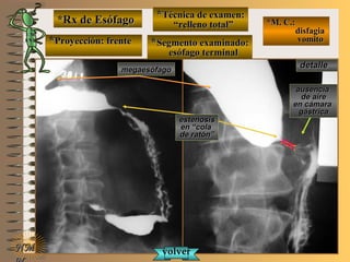 E ME M
UNTUNT
*Rx de Esófago*Rx de Esófago
**Proyección: frenteProyección: frente
**Técnica de examen:Técnica de examen:
““relleno total”relleno total”
**Segmento examinado:Segmento examinado:
esófago terminalesófago terminal
*M. C.:*M. C.:
disfagiadisfagia
vomitovomito
NMNM
detalledetalle
megaesófagomegaesófago
estenosisestenosis
en “colaen “cola
de ratón”de ratón”
volvervolver
ausenciaausencia
de airede aire
en cámaraen cámara
gástricagástrica
 