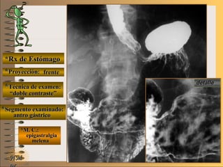 E ME M
UNTUNT
*Rx de Estómago*Rx de Estómago
**Proyección:Proyección:
**Técnica de examen:Técnica de examen:
**Segmento examinado:Segmento examinado:
*M. C.:*M. C.:
epigastralgiaepigastralgia
melenamelena
NMNM
detalledetalle
frentefrente
““doble contraste”doble contraste”
antro gástricoantro gástrico
 