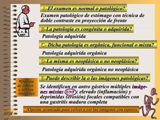 A-A-El examen es normal o patológico?El examen es normal o patológico?
Examen patológico de estómago con técnica deExamen patológico de estómago con técnica de
doble contraste en proyección de frentedoble contraste en proyección de frente
B-B-La patología es congénita o adquirida?La patología es congénita o adquirida?
Patología adquiridaPatología adquirida
C-C- Dicha patología es orgánica, funcional o mixta?Dicha patología es orgánica, funcional o mixta?
**OpciónOpción
de volverde volver
a ver lasa ver las
imágenesimágenes
Patología adquirida orgánicaPatología adquirida orgánica
D-D-La misma es neoplásica o no neoplásica?La misma es neoplásica o no neoplásica?
Patología adquirida orgánica no neoplásicaPatología adquirida orgánica no neoplásica
E-E-Puede describir la o las imágenes patológicas?Puede describir la o las imágenes patológicas?
Se identifican en antro gástrico múltiplesSe identifican en antro gástrico múltiples imáge-imáge-
nes mixtasnes mixtas UNTUNT : elevado (inflamación) y: elevado (inflamación) y
deprimidas (erosión) focales compatibles condeprimidas (erosión) focales compatibles con
una gastritis madura completauna gastritis madura completa
**Opción avanzada para volver a ver las imágenes con reparosOpción avanzada para volver a ver las imágenes con reparos
NMNM
D. F. M.D. F. M.
UNTUNT
E ME M
UNTUNT
 