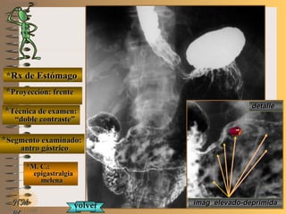 E ME M
UNTUNT
*Rx de Estómago*Rx de Estómago
**Proyección: frenteProyección: frente
**Técnica de examen:Técnica de examen:
““doble contraste”doble contraste”
**Segmento examinado:Segmento examinado:
antro gástricoantro gástrico
*M. C.:*M. C.:
epigastralgiaepigastralgia
melenamelena
NMNM
detalledetalle
imágimág.. elevado-deprimidaelevado-deprimidavolvervolver
 