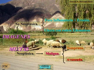 Foto de N. Mercado NietoFoto de N. Mercado Nieto
IMAGENESIMAGENES
MIXTASMIXTAS
No Neoplásica.No Neoplásica.
Neoplásica.Neoplásica.
Foco Inflamatorio + Erosión.Foco Inflamatorio + Erosión.
Ulcera con rodete Edematoso.Ulcera con rodete Edematoso.
Maligna.Maligna.
Temprana.Temprana.
AvanzadaAvanzada..
NMNM volvervolver
 