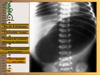 E ME M
UNTUNT
*Rx de Estómago*Rx de Estómago
**Proyección:Proyección:
**Técnica de examen:Técnica de examen:
**Segmento examinado:Segmento examinado:
*M. C.:neonato*M. C.:neonato
con vómitocon vómito
NMNM
frentefrente
““directa de abdomen”directa de abdomen”
panorámicapanorámica
 