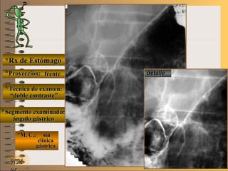 E ME M
UNTUNT
*Rx de Estómago*Rx de Estómago
**Proyección:Proyección:
**Técnica de examen:Técnica de examen:
**Segmento examinado:Segmento examinado:
*M. C.: sin*M. C.: sin
clínicaclínica
gástricagástrica
NMNM
detalledetallefrentefrente
““doble contraste”doble contraste”
ángulo gástricoángulo gástrico
 