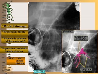 E ME M
UNTUNT
*Rx de Estómago*Rx de Estómago
**Proyección: frenteProyección: frente
**Técnica de examen:Técnica de examen:
““doble contraste”doble contraste”
**Segmento examinado:Segmento examinado:
ángulo gástricoángulo gástrico
*M. C.: sin*M. C.: sin
clínicaclínica
gástricagástrica
NMNM
detalledetalle
plieguespliegues
depresióndepresión
irregularirregular
volvervolver
 