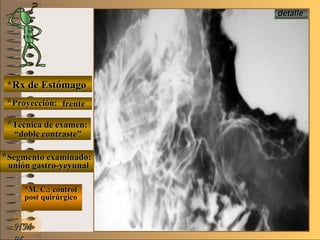 E ME M
UNTUNT
*Rx de Estómago*Rx de Estómago
**Proyección:Proyección:
**Técnica de examen:Técnica de examen:
**Segmento examinado:Segmento examinado:
*M. C.: control*M. C.: control
post quirúrgicopost quirúrgico
NMNM
detalledetalle
frentefrente
““doble contraste”doble contraste”
unión gastro-yeyunalunión gastro-yeyunal
 