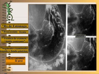 E ME M
UNTUNT
*Rx de Estómago*Rx de Estómago
**Proyección:Proyección:
**Técnica de examen:Técnica de examen:
**Segmento examinado:Segmento examinado:
*M. C.: pérdida*M. C.: pérdida
de pesode peso
NMNM
detalledetalle
frentefrente
““doble contraste”doble contraste”
ángulo y fondo gástricoángulo y fondo gástrico
 