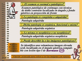 A-A-El examen es normal o patológico?El examen es normal o patológico?
Examen patológico de estómago con técnicaExamen patológico de estómago con técnica
de doble contraste localizada en ángulo y fondode doble contraste localizada en ángulo y fondo
gástrico en proyección de frentegástrico en proyección de frente
B-B-La patología es congénita o adquirida?La patología es congénita o adquirida?
Patología adquiridaPatología adquirida
D-D-La misma es neoplásica o no neoplásica?La misma es neoplásica o no neoplásica?
**OpciónOpción
de volverde volver
a ver lasa ver las
imágenesimágenes
Patología adquirida orgánica neoplásicaPatología adquirida orgánica neoplásica
E-E-Puede describir la o las imágenes patológicas?Puede describir la o las imágenes patológicas?
Se identifica una voluminosa imagen elevadaSe identifica una voluminosa imagen elevada
sesil, localizada en el ángulo gástrico compati-sesil, localizada en el ángulo gástrico compati-
ble con lesión tipo I deble con lesión tipo I de BorrmannBorrmann UNTUNT
NMNM
C-C-Dicha patología es orgánica, funcional o mixta?Dicha patología es orgánica, funcional o mixta?
Patología adquirida orgánicaPatología adquirida orgánica
**Opción avanzada para volver a ver las imágenes con reparosOpción avanzada para volver a ver las imágenes con reparos
D. F. M.D. F. M.
UNTUNT
E ME M
UNTUNT
 