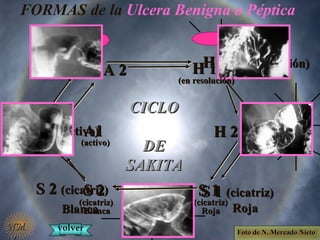 CICLOCICLO
DEDE
SAKITASAKITA
A1A1 (activo)(activo)
A 2A 2 H 1H 1 (en resolución)(en resolución)
H 2H 2
S 1S 1 (cicatriz)(cicatriz)
RojaRoja
S 2S 2 (cicatriz)(cicatriz)
BlancaBlanca
FORMAS de la Ulcera Benigna o Péptica
A1A1
(activo)(activo)
A 2A 2 H 1H 1
(en resolución)(en resolución)
H 2H 2
S 1S 1
(cicatriz)(cicatriz)
RojaRoja
S 2S 2
(cicatriz)(cicatriz)
BlancaBlanca
volvervolver Foto de N. Mercado NietoFoto de N. Mercado Nieto
NMNM
 