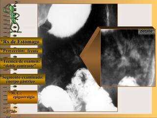 E ME M
UNTUNT
*Rx de Estómago*Rx de Estómago
**Proyección:Proyección:
**Técnica de examen:Técnica de examen:
**Segmento examinado:Segmento examinado:
*M. C.:*M. C.:
epigastralgiaepigastralgia
NMNM
detalledetalle
frentefrente
““doble contraste”doble contraste”
cuerpo gástricocuerpo gástrico
 