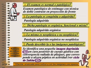 A-A-El examen es normal o patológico?El examen es normal o patológico?
Examen patológico de estómago con técnicaExamen patológico de estómago con técnica
de doble contraste en proyección de frentede doble contraste en proyección de frente
B-B-La patología es congénita o adquirida?La patología es congénita o adquirida?
Patología adquiridaPatología adquirida
C-C- Dicha patología es orgánica, funcional o mixta?Dicha patología es orgánica, funcional o mixta?
**OpciónOpción
de volverde volver
a ver lasa ver las
imágenesimágenes
Patología adquirida orgánicaPatología adquirida orgánica
D-D-La misma es neoplásica o no neoplásica?La misma es neoplásica o no neoplásica?
Patología adquirida orgánica no neoplásicaPatología adquirida orgánica no neoplásica
E-E-Puede describir la o las imágenes patológicas?Puede describir la o las imágenes patológicas?
Se identifica una pequeñaSe identifica una pequeña imagen deprimidaimagen deprimida
UNTUNT en cara posterior de cuerpo gástrico conen cara posterior de cuerpo gástrico con
convergencia radiada de pliegues, que corres-convergencia radiada de pliegues, que corres-
ponde a ulcera péptica en actividad (verponde a ulcera péptica en actividad (ver ciclociclo
de Sakitade Sakita UNTUNT ))
**Opción avanzada para volver a ver las imágenes con reparosOpción avanzada para volver a ver las imágenes con reparosNMNM
D. F. M.D. F. M.
UNTUNT
E ME M
UNTUNT
 