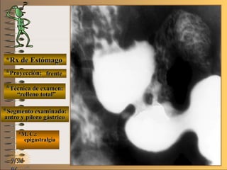 E ME M
UNTUNT
*Rx de Estómago*Rx de Estómago
**Proyección:Proyección:
**Técnica de examen:Técnica de examen:
**Segmento examinado:Segmento examinado:
*M. C.:*M. C.:
epigastralgiaepigastralgia
NMNM
frentefrente
““relleno total”relleno total”
antro y píloro gástricoantro y píloro gástrico
 