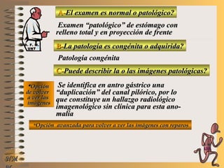 A-A-El examen es normal o patológico?El examen es normal o patológico?
Examen “patológico” de estómago conExamen “patológico” de estómago con
relleno total y en proyección de frenterelleno total y en proyección de frente
B-B-La patología es congénita o adquirida?La patología es congénita o adquirida?
Patología congénitaPatología congénita
C-C-Puede describir la o las imágenes patológicas?Puede describir la o las imágenes patológicas?
**OpciónOpción
de volverde volver
a ver lasa ver las
imágenesimágenes
Se identifica en antro gástrico unaSe identifica en antro gástrico una
““duplicación” del canal pilórico, por loduplicación” del canal pilórico, por lo
que constituye un hallazgo radiológicoque constituye un hallazgo radiológico
imagenológico sin clínica para esta ano-imagenológico sin clínica para esta ano-
malíamalía
**Opción avanzada para volver a ver las imágenes con reparosOpción avanzada para volver a ver las imágenes con reparos
NMNM
D. F. M.D. F. M.
UNTUNT
E ME M
UNTUNT
 